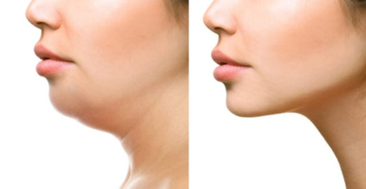 Cara Menghilangkan Double Chin, Miliki Wajah V-Shape!